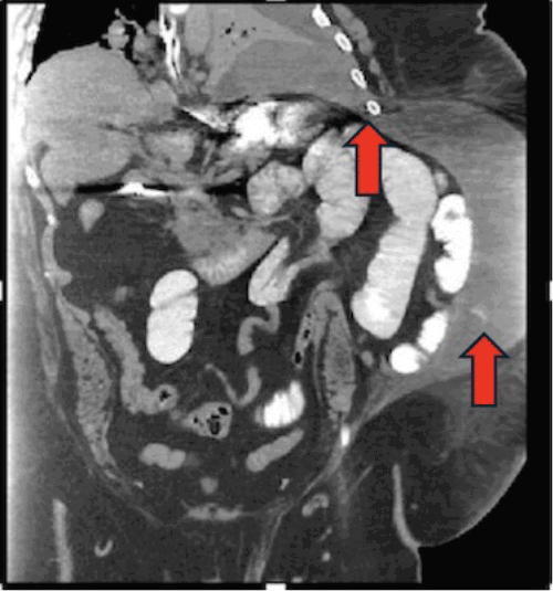 Image shows extraperitoneal collection of fluid and gas within the left abdominal wall (arrow), consistent with bowel perforation within the hernia sac. Note the evidence of contrast extravasation and a communicating tract (arrow) extending from this collection superiorly towards the left pleural cavity