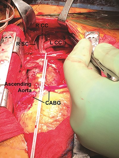Figure 2. Intraoperative image of a bifurcated ascending aorta to right subclavian and right common carotid artery bypass (under the preserved innominate vein retracted and marked by white vessel loop), right to left common carotid artery bypass, and two ascending aorta-coronary artery saphenous vein grafts. R SC: right subclavian artery graft, R CC: right common carotid artery graft, L CC: left common carotid artery graft, CABG: saphenous vein coronary artery bypass grafts.