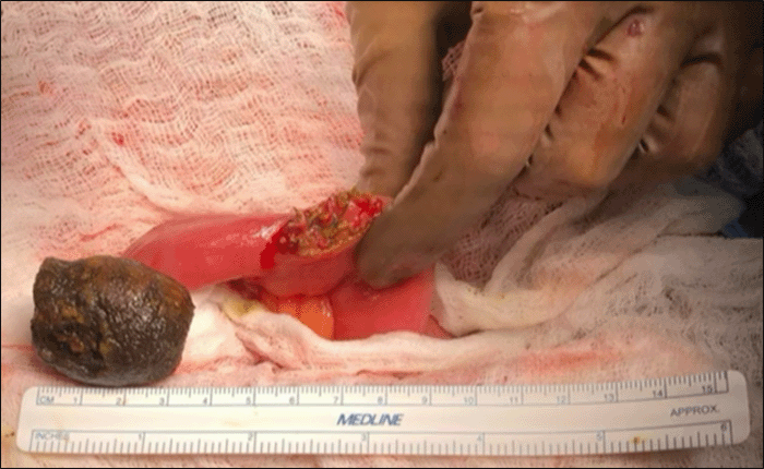B) Surgical retrieval of the gallstone via enterolithotomy.
