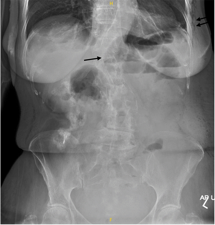 Abdominal radiograph obtained on POD 2. The image demonstrates minimally dilated small bowel loops in the left upper quadrant (single arrow) and diffuse subcutaneous emphysema throughout the soft tissues of the left abdominal wall (double arrow)