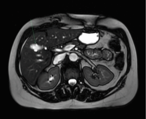 C) MRCP demonstrates dilated intrahepatic ducts draining segments 4B and 5 (IH 4B/5) into the remnant of the cystic duct (R-CD) following cholecystectomy.