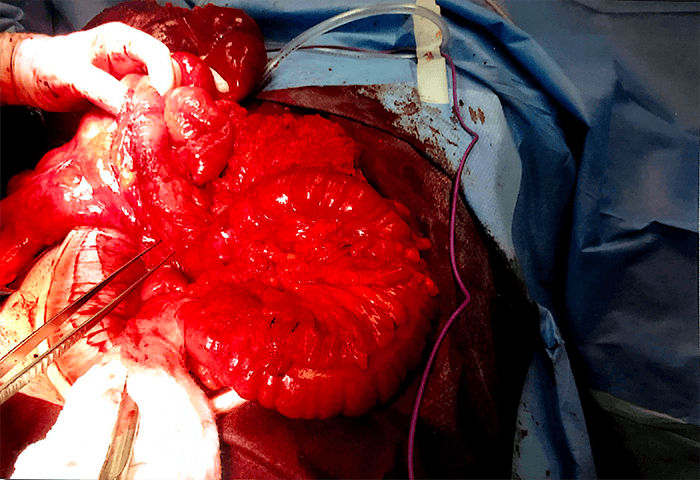 Figure 2. Anterior view of anomalous colon in situ after reflection of anterior abdominal wall. Greater omentum has been reflected upwards. Note the size of the cecum. Jejunum and ileum were occupying right part of the abdomen and transverse colon was found in a diagonal position. 
