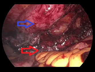 Figure 4. The blue arrow marks the imbricated fascia, the red arrow marks the flap of peritoneum. 