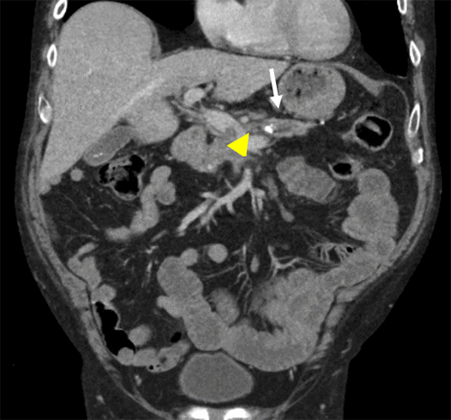 Scans demonstrate a pancreatolith (white arrow) with upstream pancreatic duct dilation and focal pancreatic necrosis (yellow arrow). There is a small thrombus located in the adjacent SMV (arrowhead).