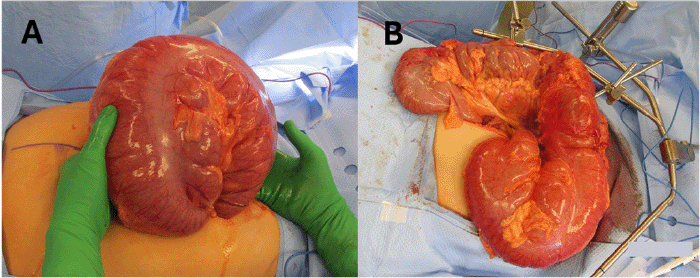(A) Eviscerated dilated colon demonstrating the severely distended segment involved in the splenic flexure volvulus, prior to detorsion; note the viable appearance without overt signs of ischemia or perforation. (B) Appearance of the ascending, transverse, and descending colon after successful manual detorsion of the splenic flexure volvulus, illustrating the resolution of the torsion and restoration of more normal anatomical alignment, though with persistent dilatation