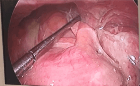 Figure 2. Laparoscopic view of abdomen, inflamed appendix adhered to right hernial orifice