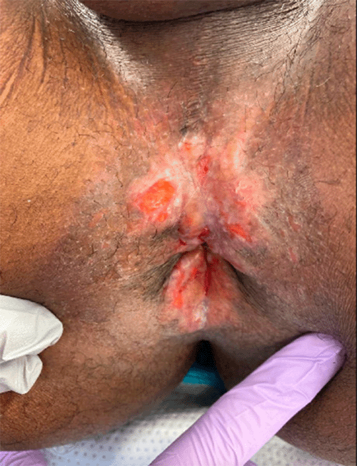 Lesions observed during examination under anesthesia