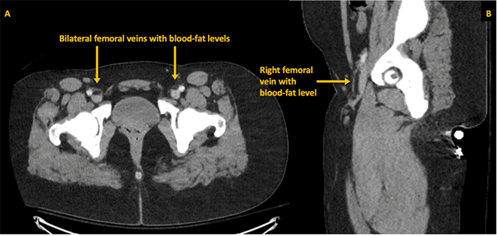 CT of the abdomen and pelvis. (A) Axial view and (B) Sagittal reformatted view. Both images reveal low-attenuation material (approximately -100 Hounsfield units, arrows) within the bilateral femoral veins, forming distinct blood-fat levels. These findings are consistent with fat emboli in transit