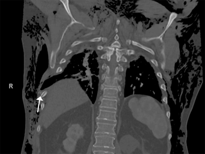 Operative Rib Fixation Traumatic Lung Herniation, Repair With Rib Fixation | ACS