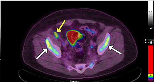 A (coronal and sagittal views): Heterogeneous and focal fluorodeoxyglucose (FDG) uptake within the spinal column, indicating bony disease involvement (white arrows). B (lower axial view): Lymphadenopathy (yellow arrow) in the mesenteric and external iliac regions alongside bony involvement of the pelvic bones (white arrows)