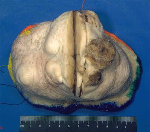 B) Excised tumor specimen revealing a focus containing characteristic keratinaceous debris. Note the unremarkable overlying scalp with preserved hair follicles