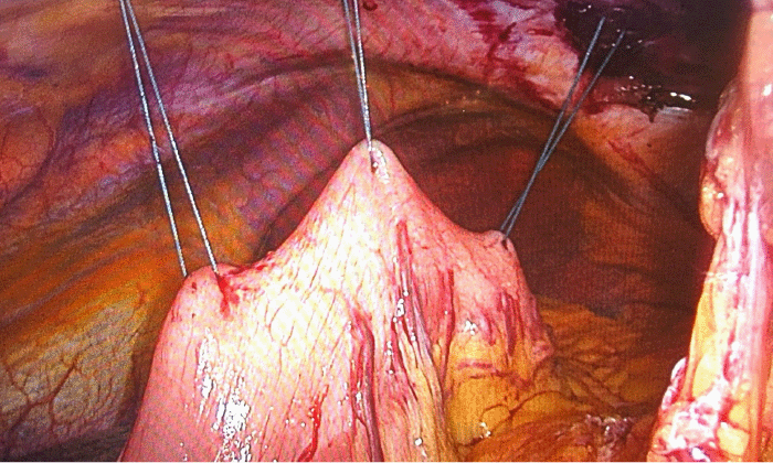 Operation was achieved with three non-absorbable seromuscular sutures placed intracorporeally along the greater curvature of the stomach.