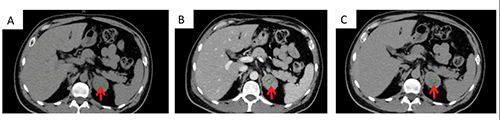 Figure 1. Computed tomography of abdomen confirming a 4 x 4 cm left adrenal mass on axial view. A: Precontrast view, 40 HU; B: Postconstrast view, 83 HU; C: Washout seen with 15 minute delayed view with contrast, 52 HU