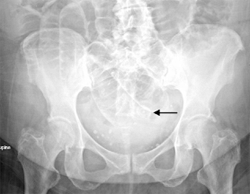 Distended Transverse Colon