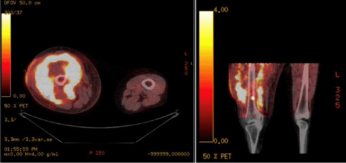 Axial and coronal PET-CT images of the bilateral thighs demonstrating an intensely fluorodeoxyglucose (FDG)-avid mass in the right thigh, extending into the distal femur and knee joint