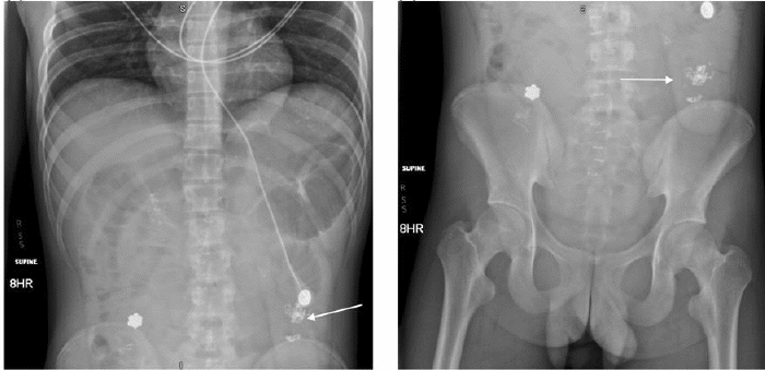 Small bowel follow-through radiographs, obtained after an 8-hour delay following oral contrast ingestion, revealing a trace amount of contrast in the distal small bowel (white arrow). (Left) Upper abdomen view and (right) lower abdomen view