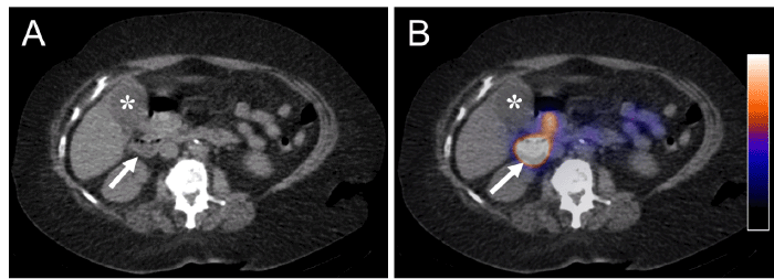 Axial CT (A) and fused SPECT/CT (B) images of the abdomen at the level of the gallbladder demonstrate excreted radiotracer within the duodenum (white arrows) without evidence of radiotracer within the gallbladder more anteriorly (*)