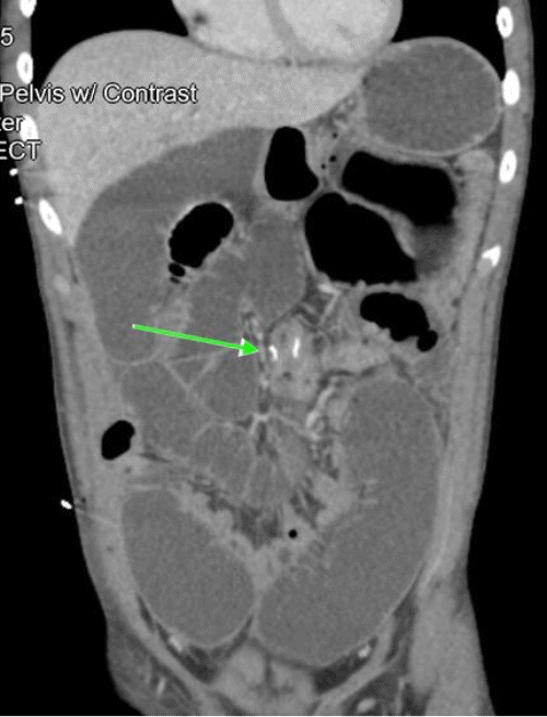 (D) Sagittal view of the ileocolic anastomosis (green arrow)
