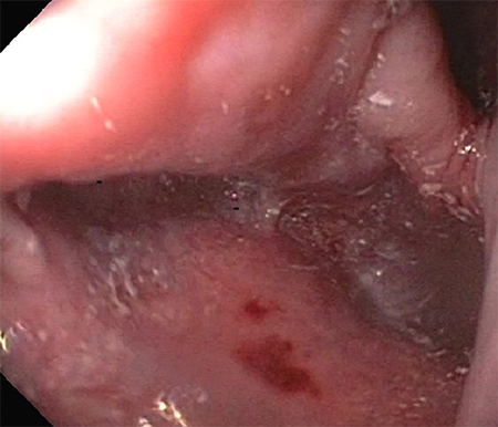 Figure 2. Image of the EGD that shows the inner surface of the large, proximal esophageal diverticulum with the lumen of the esophagus in the upper right corner.