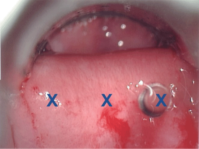 Injection sites are marked with "X"