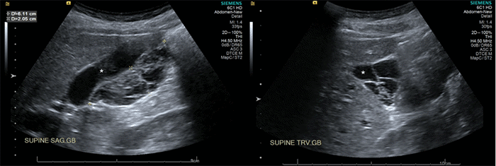 Sagittal (L) and transverse (R) views: Gallbladder (*) demonstrating a cystic mass with septations