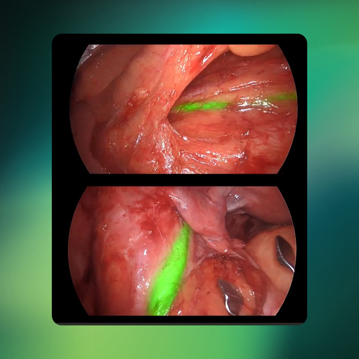 Fluorescence-Guided Surgery Is Beginning to Extend Beyond Oncology