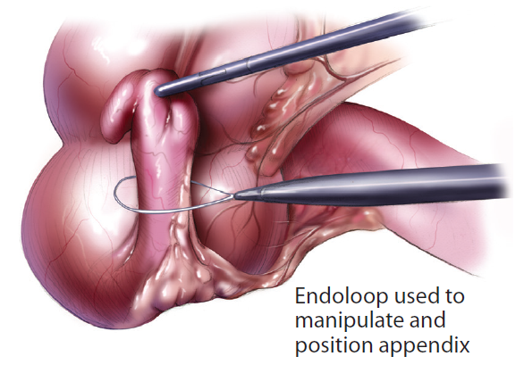 Appendectomy | ACS
