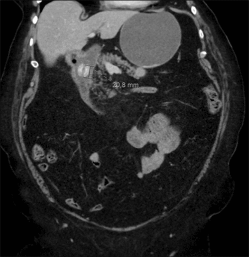 Coronal CT image demonstrating a gallstone within a small bowel loop in the right upper quadrant, with no evidence of distal small bowel dilation