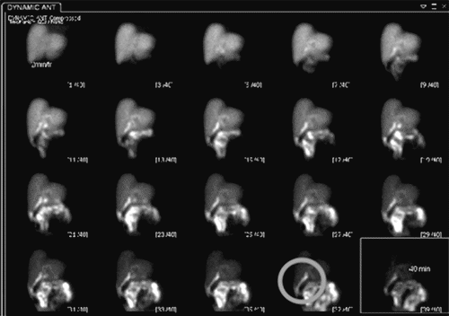 Gallbladder Rupture Lung Delayed Presentation of Isolated Traumatic Gallbladder Rupture with ...
