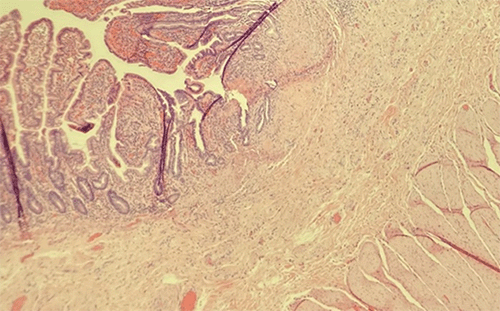 Mild ulceration of the mucosa with submucosal tethering and fibrosis present.