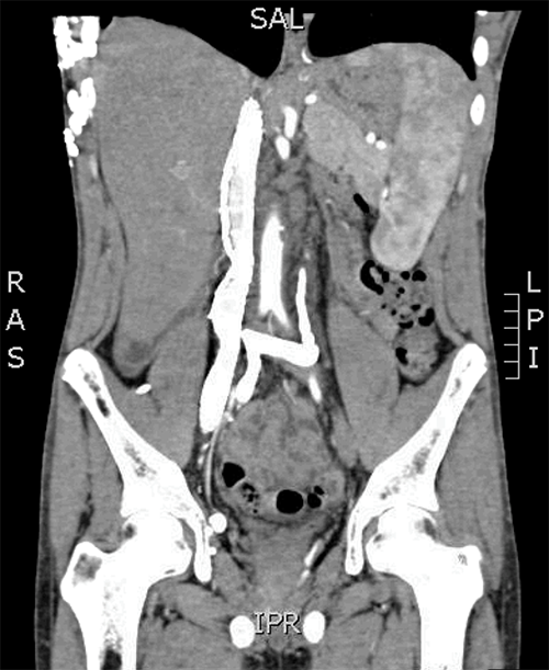 A) Scan shows the self-expanding stent in the right EIV, CIV, and the entire length of IVC. 