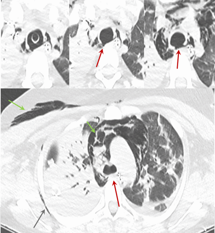 Top: Sequential axial images in lung windows show that immediately inferior to the ET tube, there is apparent discontinuity of the posterior trachea (red). Bottom: Origin of the mainstem bronchi appears intact (red). Mediastinal and soft tissue emphysema (green) are noted as well as atelectasis (blue).