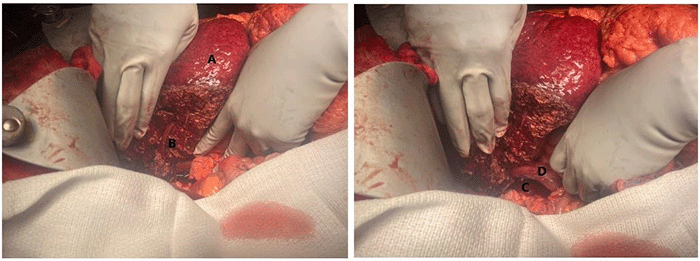 A) Cirrhotic liver morphology, B) intra-parenchymal right hepatic vein, C) retrocaval tumor cavity previously occupied by the resected tumor, now displacing the inferior vena cava D) ventrally from its normal anatomical position