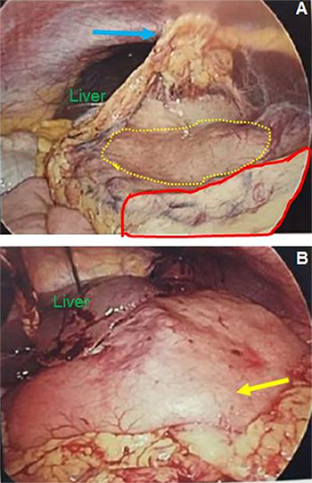 Figure 2. Intraoperative images of the second surgery after diagnosis of gastric volvulus