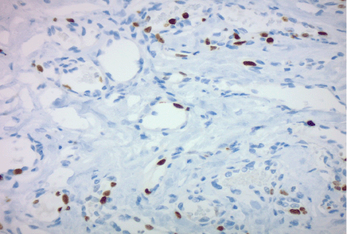 D) Ki-67 immunohistochemistry demonstrating increased mitotic activity