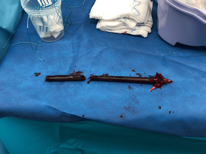 Figure 4. Removed foreign body: the arrow from the crossbow in pieces