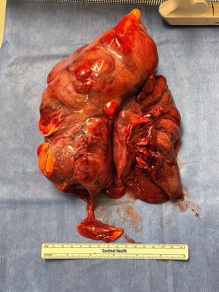 Gross pathological examination of the resected mesenchymal tumor, demonstrating chondromatous, heterologous elements. The mass measured 25.0 × 13.0 × 12.5 cm, and resection margins were negative for malignancy