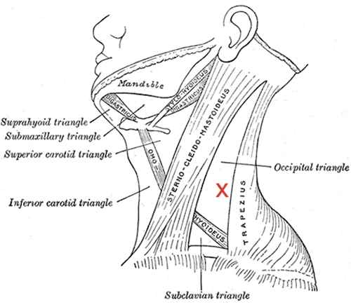 Schematic representation of the left posterior triangle of the neck (X indicates the palpable neck lesion). (Reprinted from Wikimedia Commons, 1918.)