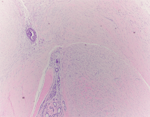 B) The sweeping fascicles of spindle cells are seen infiltrating between normal ducts and lobules