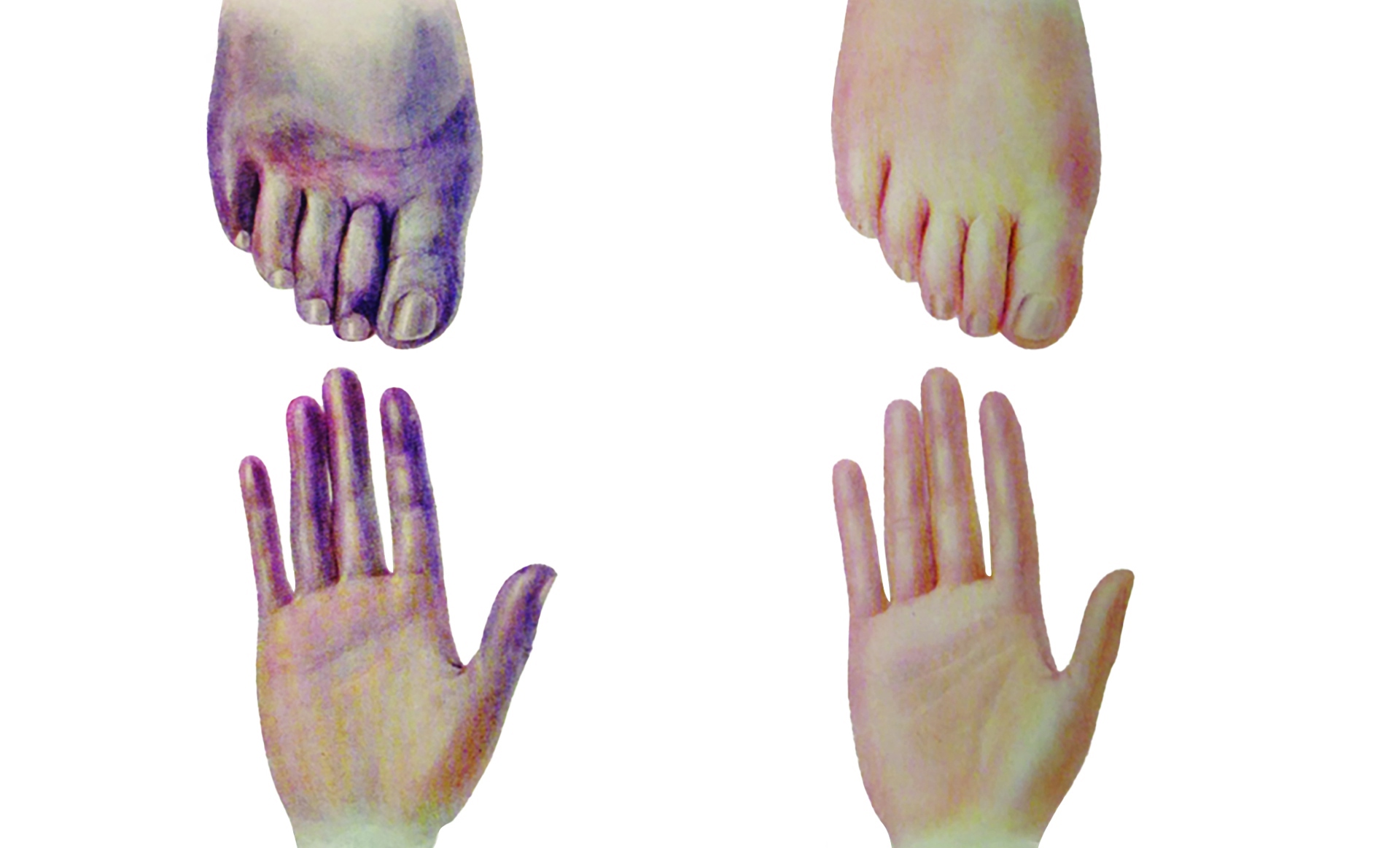 Sympathectomy Has Two-Decade Prominence in Treating Peripheral Arterial Disease