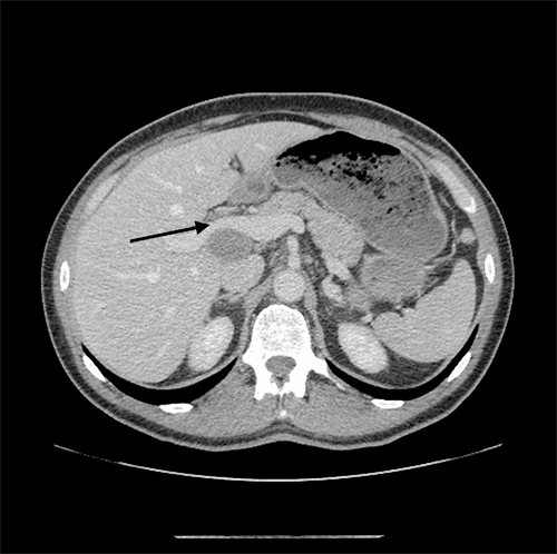 Figure 1: CT Figure showing large portal nodes (arrow to enlarged node)