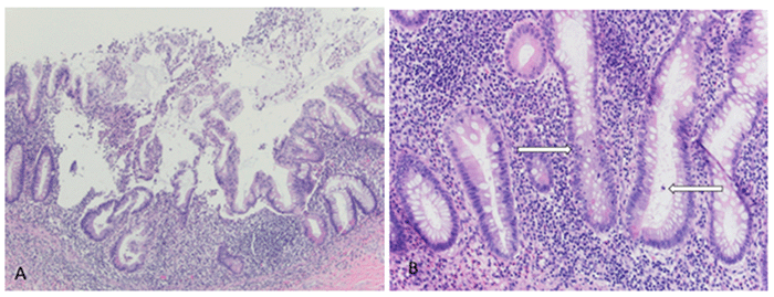(A) Appendix with intraluminal and lamina propria neutrophilic infiltrates (H&E), original magnification x10); and (B) appendiceal neutrophilic infiltrates within crypt epithelium and lumina (H&E, original magnification x20, indicated by arrows)