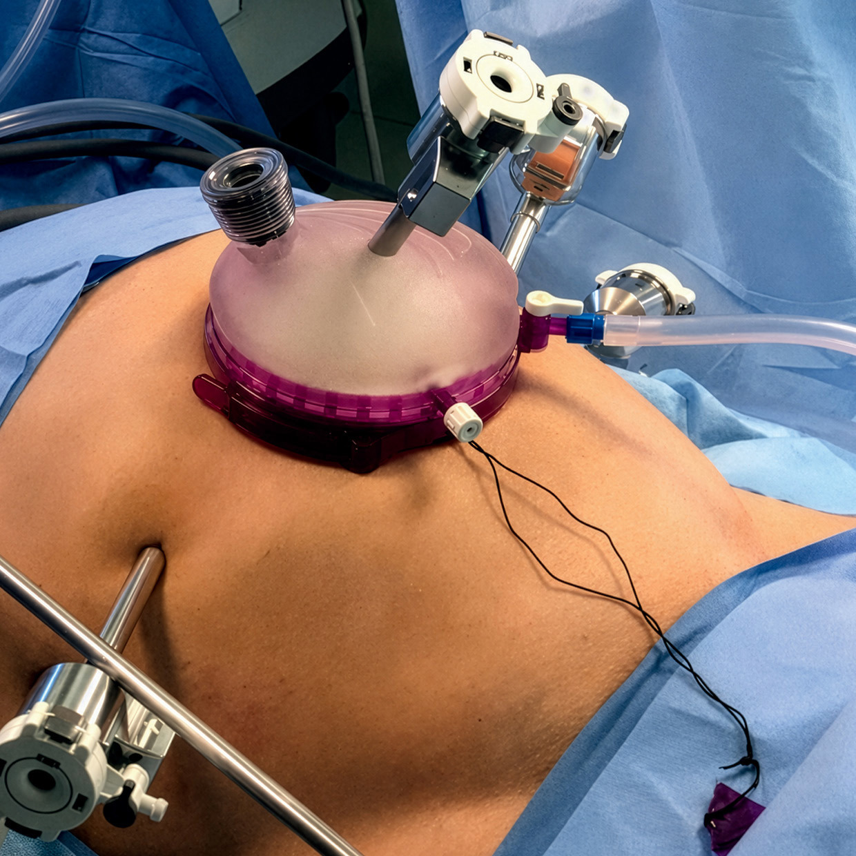 Robotic Kidney Transplant Emerges as Safe and Effective Option