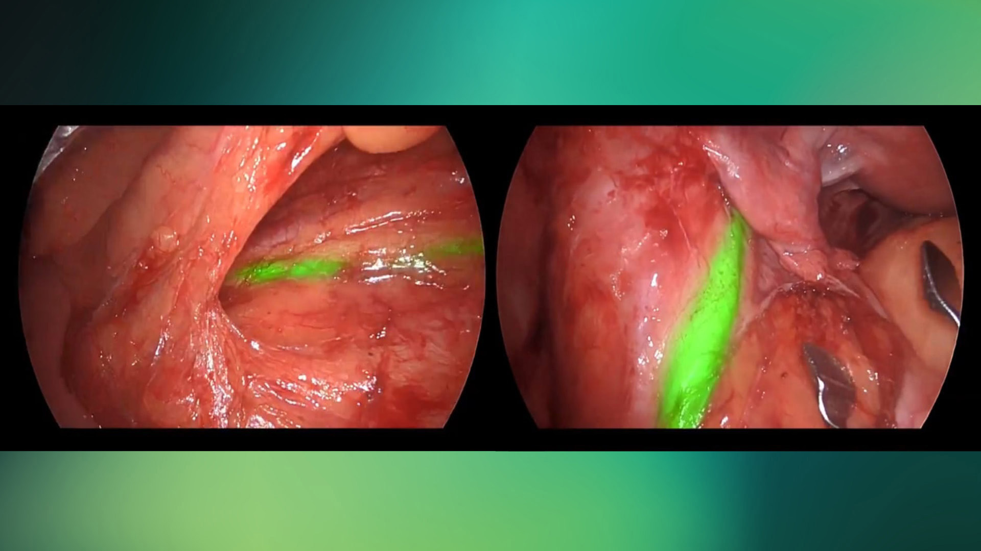 Fluorescence-Guided Surgery Is Beginning to Extend Beyond Oncology