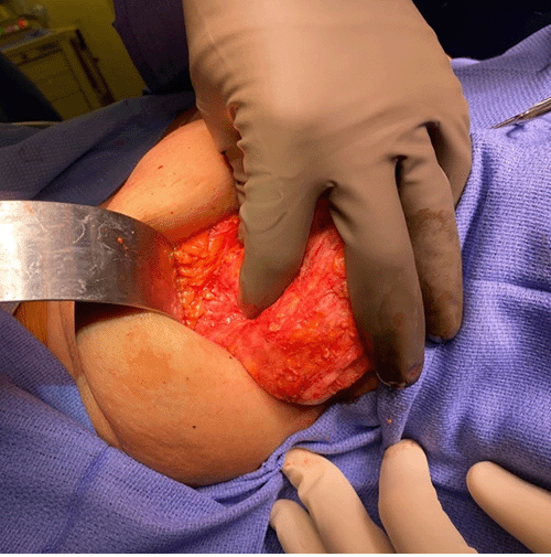 Intraoperative photograph of exposure of right breast implant capsule