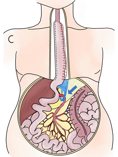C) Pathophysiological: Fibrous adhesive band tethered posteriorly to the gastric conduit, encircling the superior mesenteric artery (arrow). Tension (iatrogenic) on this adhesion during gastric conduit transposition results in acute angulation and obstruction of the vessel.