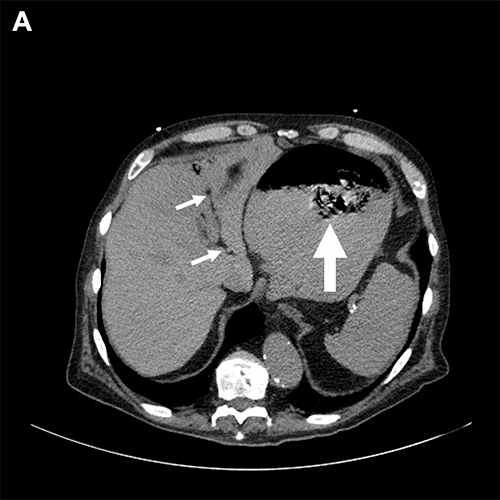 A) Cross-sectional view, upper abdomen. Large arrow = free-floating mass within lumen of stomach. Small arrows = portal venous gas