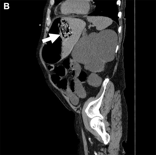 B) Sagittal view, left side