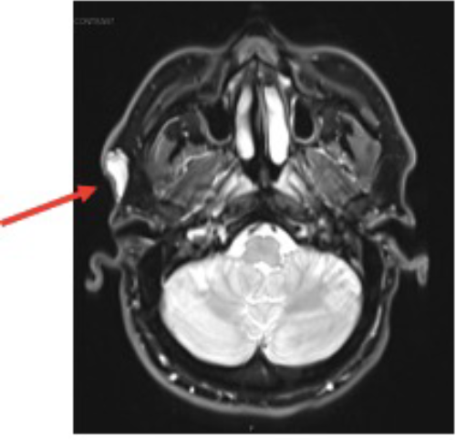 Axial T2-weighted image showing the lesion (arrow) as predominantly hyperintense with some internal heterogeneity