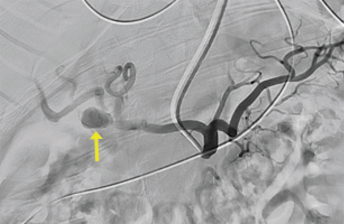 Hepatic Artery Aneurysms: An Uncommon Presentation of a Deadly Disease ...